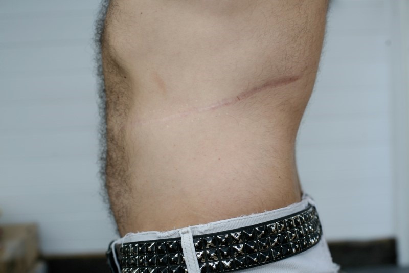 kidney-scar